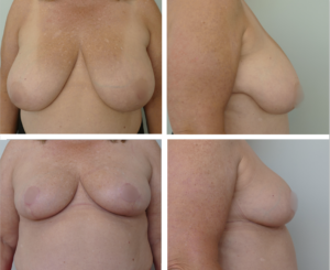 Breast Lift Portland by Dr. Tina Jenq
